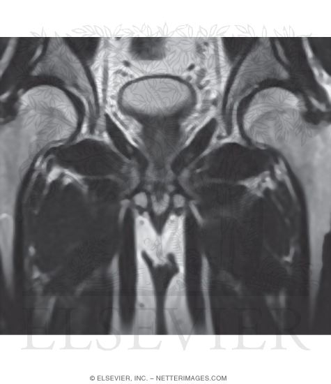 Bulb of Penis, Coronal Section