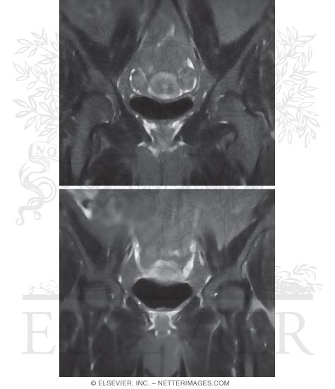 Uterus and Uterine Tube