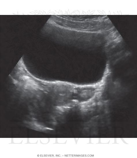 Uterus and Adnexa