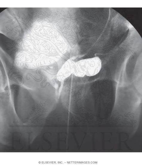 Bladder, Prostate, and Seminal Vesicles