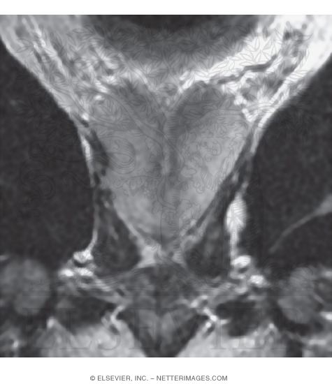 Prostate, Coronal View
