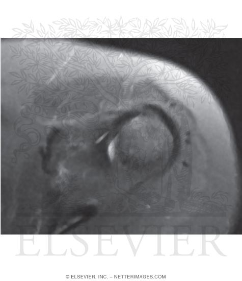 Watermarked preview of unlabeled image: Anterior View of the Shoulder Girdle