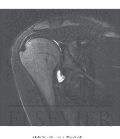 Watermarked preview of unlabeled image: Shoulder Joint, Supraspinatus Muscle