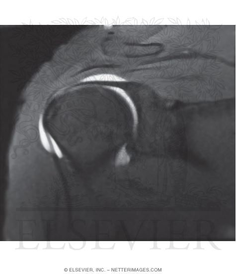 Shoulder Joint, Biceps Tendon