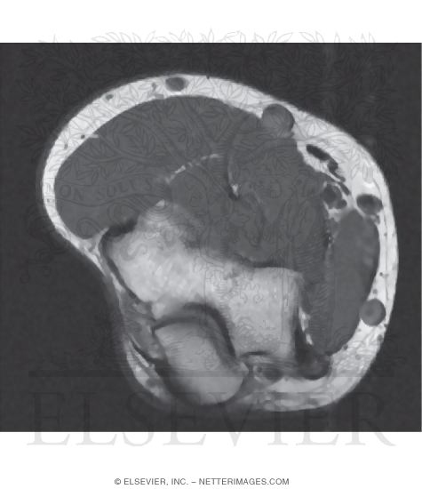 Elbow, Ulnar Nerve