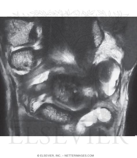 Wrist, Palmar Ligaments