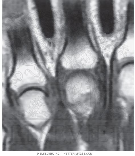 Metacarpophalangeal Joints
