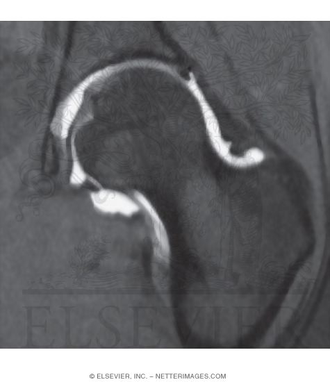 Hip Joint