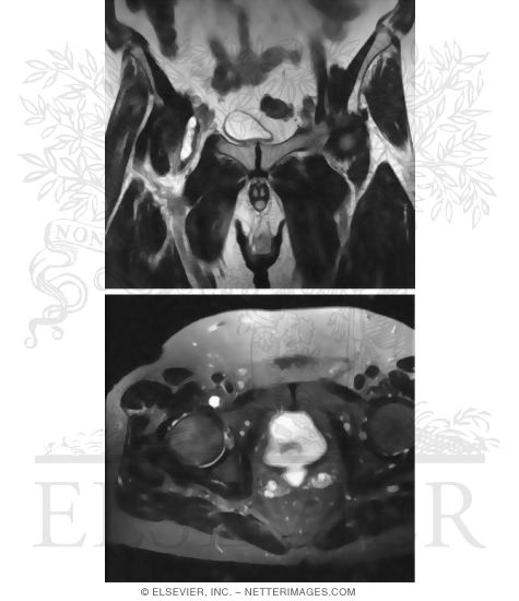 Iliopectineal Bursa