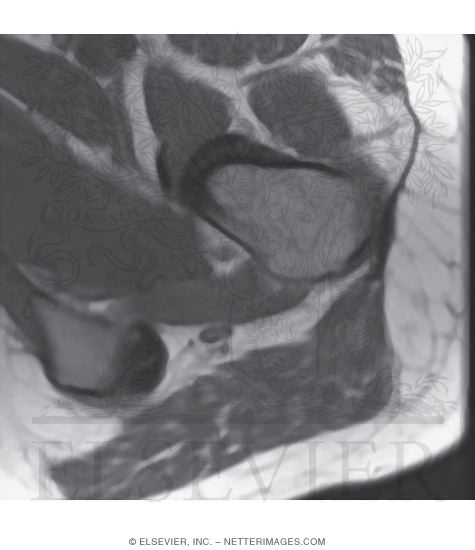 Watermarked preview of unlabeled image: Sciatic Nerve, Gluteal Region