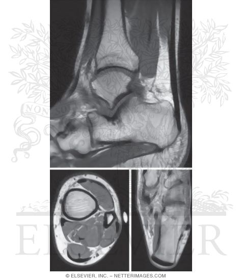 Watermarked preview of unlabeled image: Achilles' Tendon