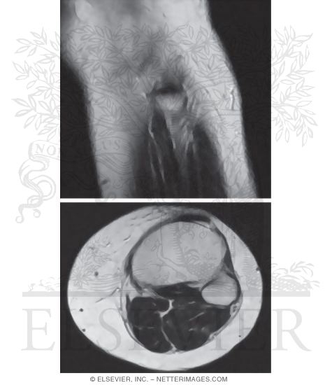 Common Fibular (peroneal) Nerve