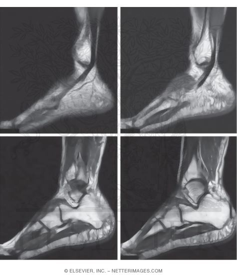 Watermarked preview of unlabeled image: Ankle Joint Muscles, Lateral View
