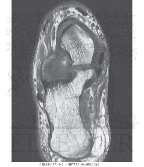 Tarsal Tunnel