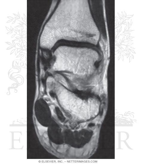 Deltoid Ligament