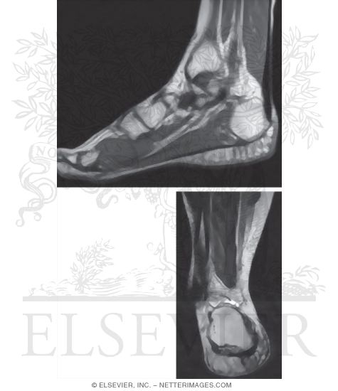 Watermarked preview of unlabeled image: Plantar Aponeurosis