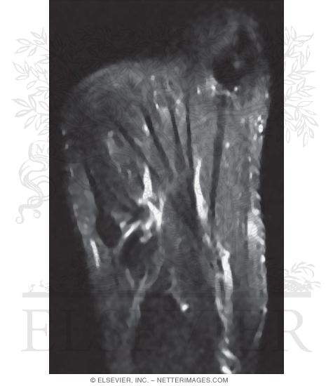 Watermarked preview of unlabeled image: Muscles of the Plantar Foot, Second Layer