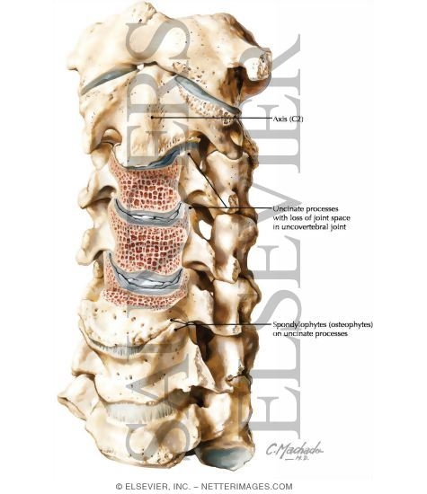 Cervical Spondylosis