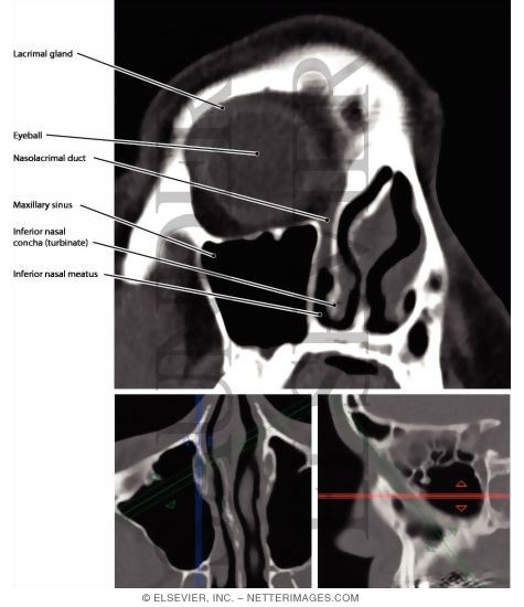 Watermarked preview of labeled image: Nasolacrimal Duct