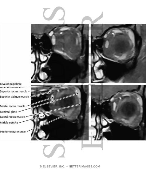 Watermarked preview of labeled image: Orbit, Coronal Section