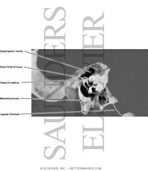 Watermarked preview of labeled image: Tympanic Cavity (Middle Ear)