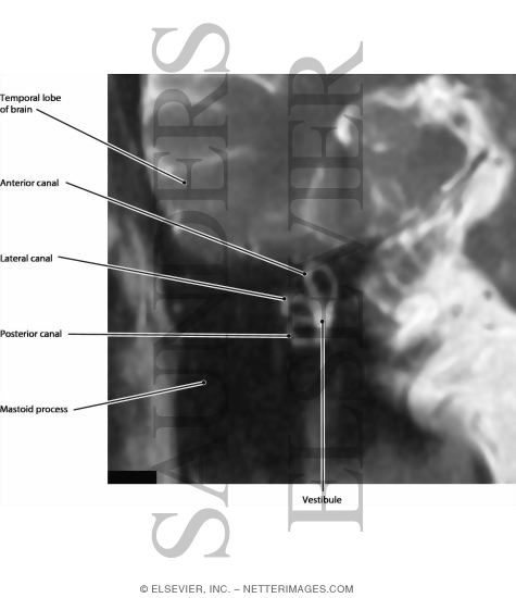 Watermarked preview of labeled image: Bony Labyrinth