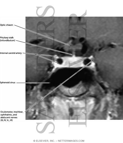 Cavernous Sinus