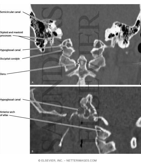 Hypoglossal Nerve (XII) and Canal