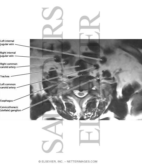 Watermarked preview of labeled image: Cervicothoracic (Stellate) Ganglion