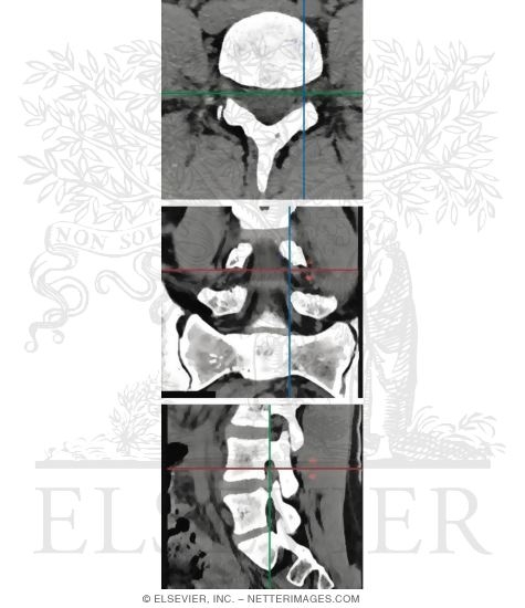 Lumbar Spine
