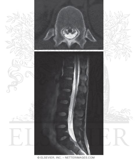 Conus Medullaris and Cauda Equina