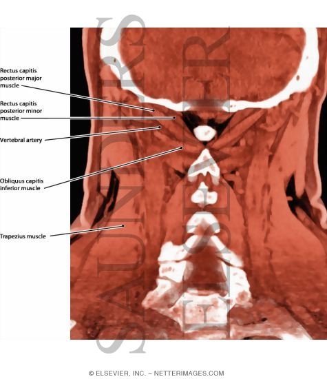 Suboccipital Triangle