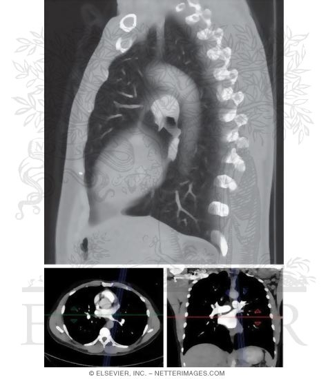 Watermarked preview of unlabeled image: Left Lung, Medial View