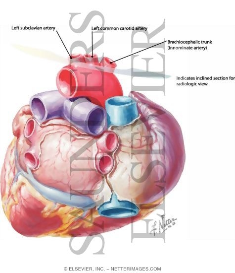 Watermarked preview of labeled image: Posterior Aspect (base) of Heart With Light Micrograph of the Wall of the Superior Vena Cava And Light Micrograph of the Wall of the Inferior Vena Cava