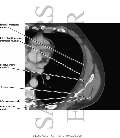 Watermarked preview of labeled image: Chest Wall Musculature