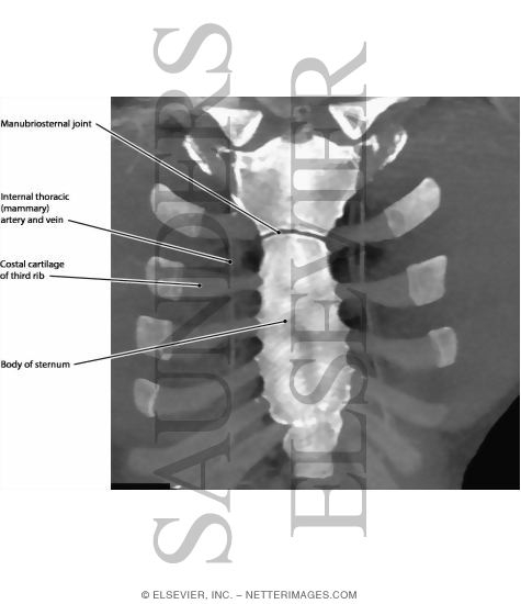 Watermarked preview of labeled image: Internal Thoracic Artery, Anterior Chest Wall