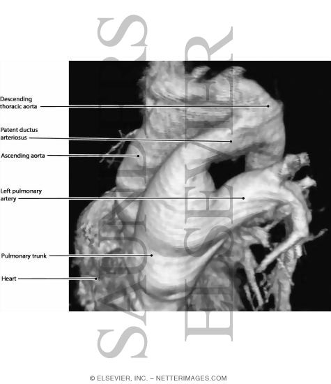 Ductus Ateriosus and Ligamentum Arteriosum