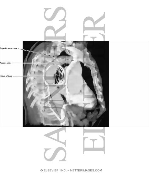 Watermarked preview of labeled image: Mediastinum, Right Lateral View