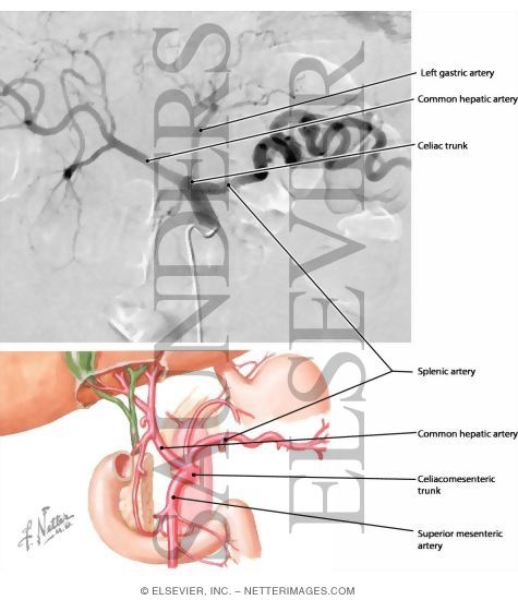 angiogram celiac axis