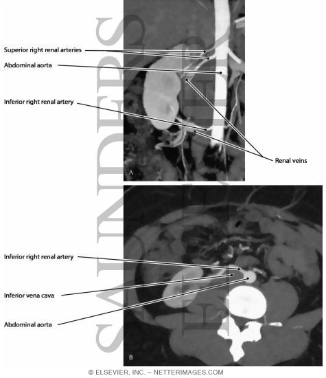 Watermarked preview of labeled image: Renal Arteries, Variation (multiple)