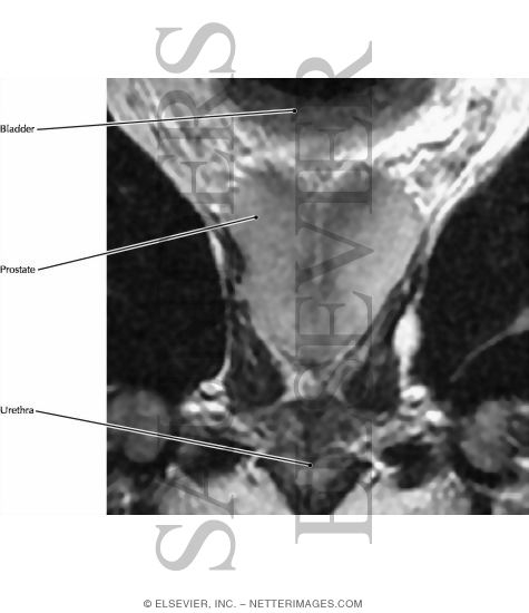 Prostate, Coronal View