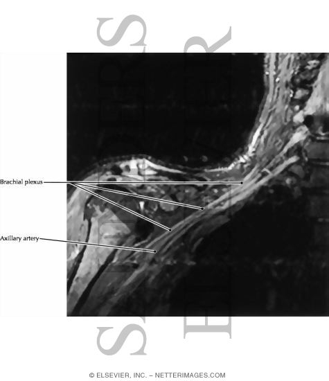 Watermarked preview of labeled image: Brachial Plexus