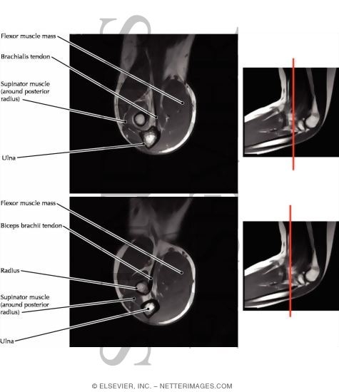 Watermarked preview of labeled image: Biceps and Brachialis Insertions