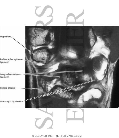 Wrist, Palmar Ligaments