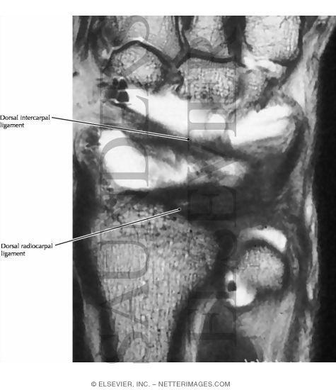 Watermarked preview of labeled image: Wrist, Dorsal Ligaments