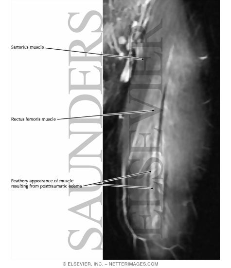 Quadriceps Femoris Muscle Group