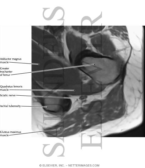 Watermarked preview of labeled image: Sciatic Nerve, Gluteal Region
