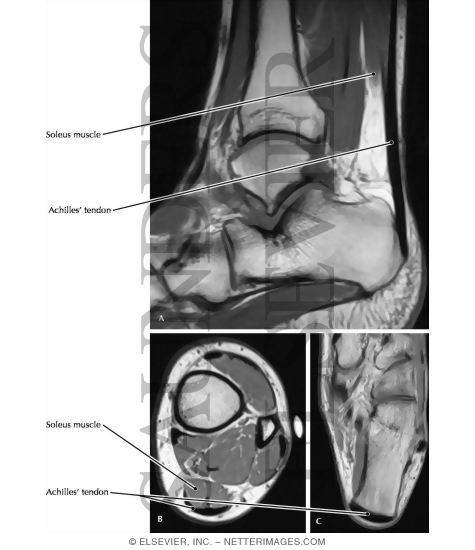 Watermarked preview of labeled image: Achilles' Tendon