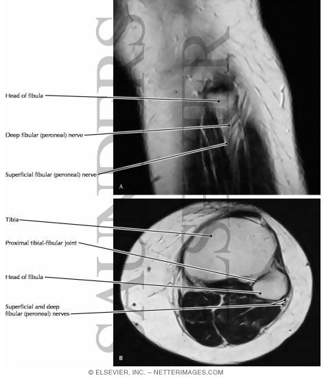 Common Fibular (peroneal) Nerve