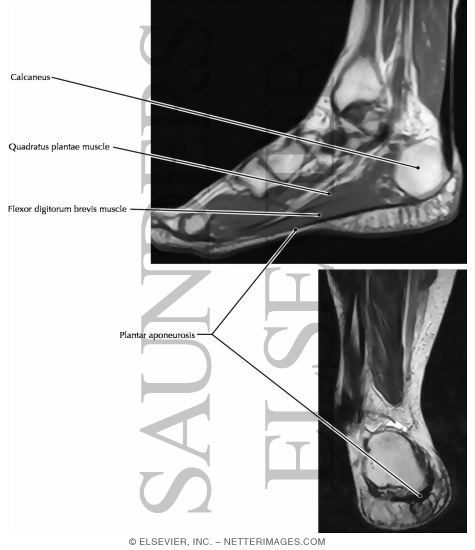 Watermarked preview of labeled image: Plantar Aponeurosis